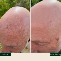 Anti-Pigment Bald Serum