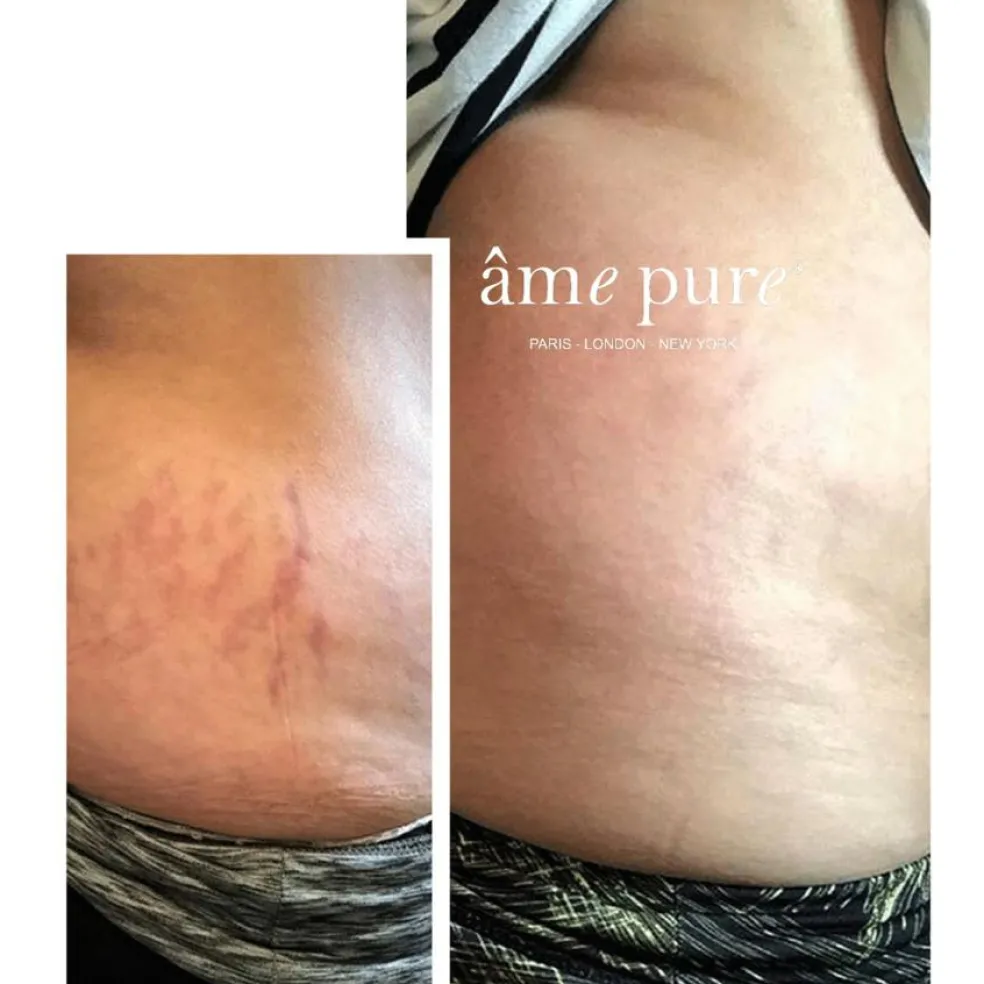 Body Basic - Stretch Marks