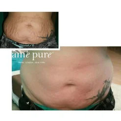 Body Basic - Stretch Marks