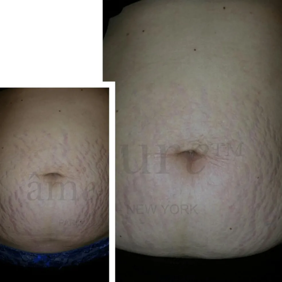 Body Basic - Stretch Marks