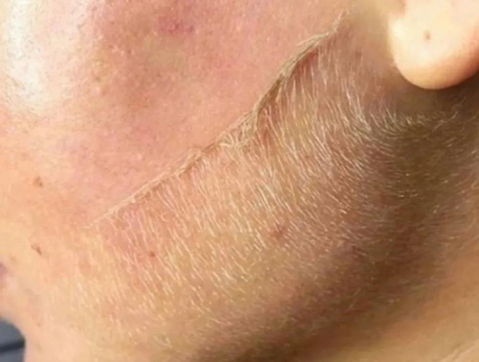 Dermaplane Razor