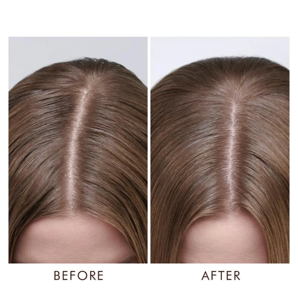 Dry Scalp Treatment