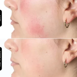 LED Face Mask 100