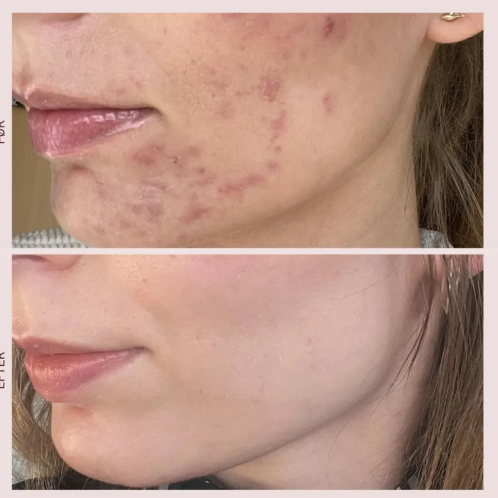 T-Zone Peeling